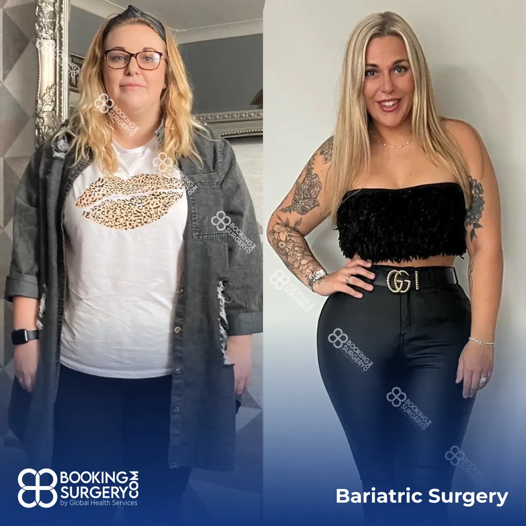 Bariatric Surgery Before After
