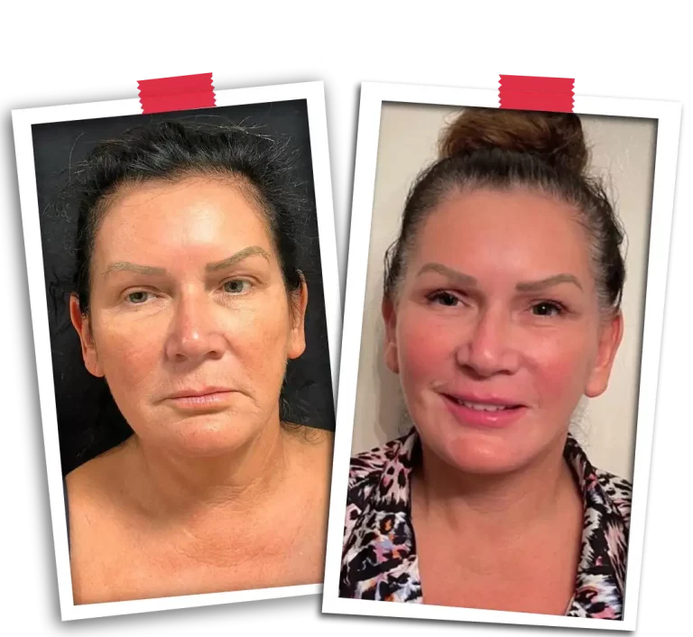 Facelift Before After-01