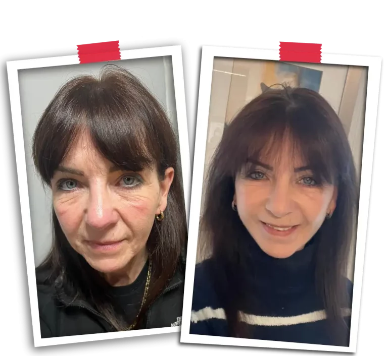 Facelift Before After-02