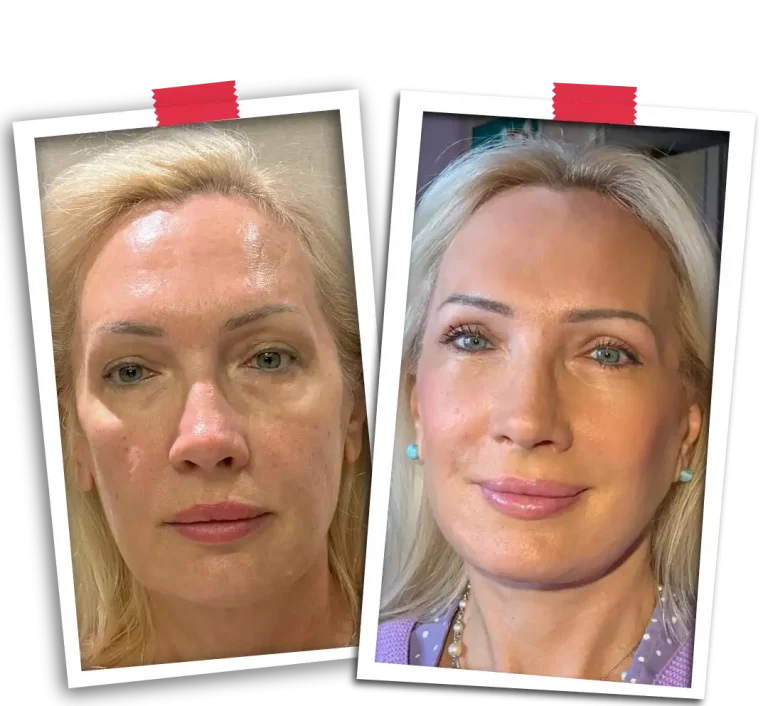 Facelift Before After-03