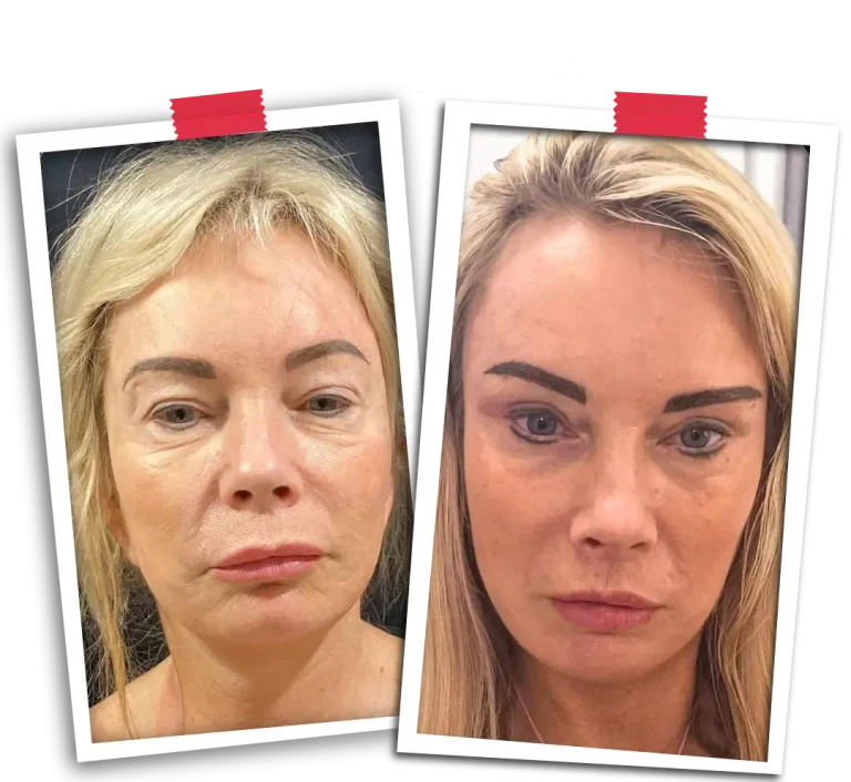 Facelift Before After-04