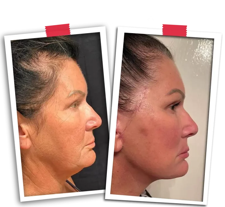Facelift Before After-05