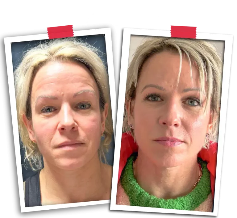 Facelift Before After-06
