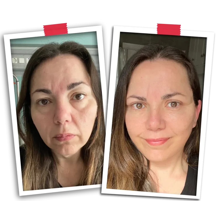 Facelift Before After-07