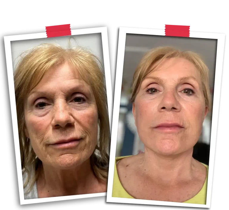 Facelift Before After-08