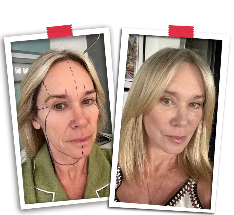 Facelift Before After-10