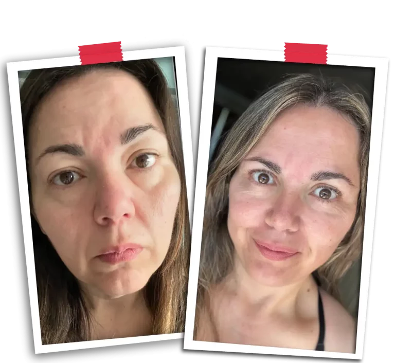 Facelift Before After-11