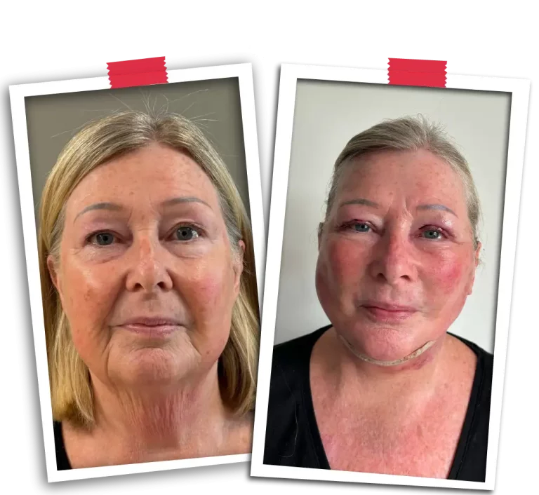 Facelift Before After-12