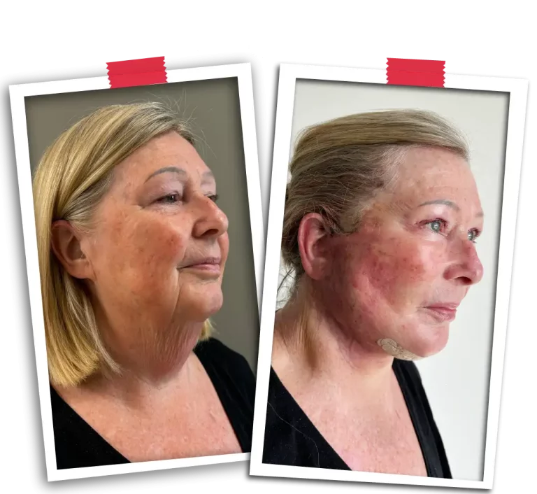 Facelift Before After-13