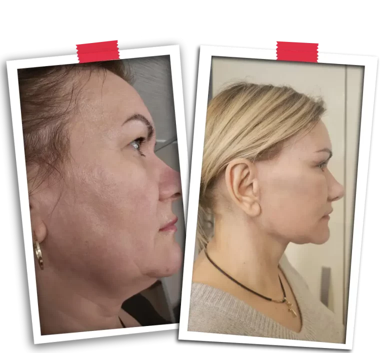 Facelift Before After-14