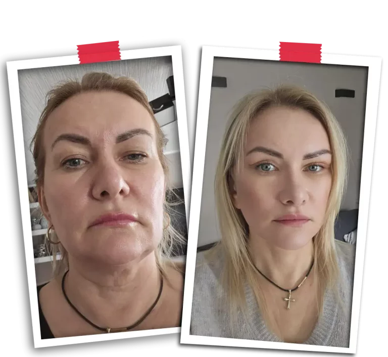 Facelift Before After-15