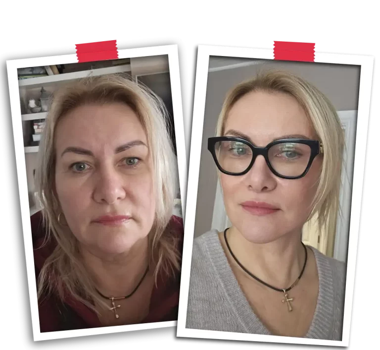 Facelift Before After-16