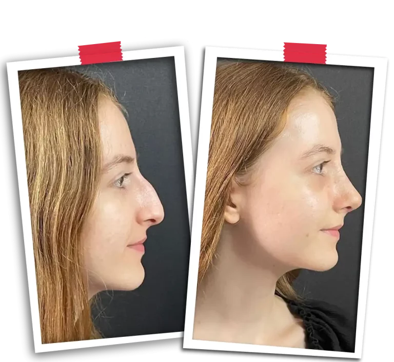 Rinoplasti Before After VP-01