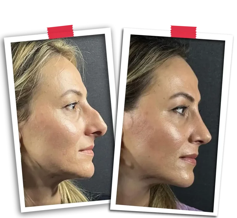 Rinoplasti Before After VP-02