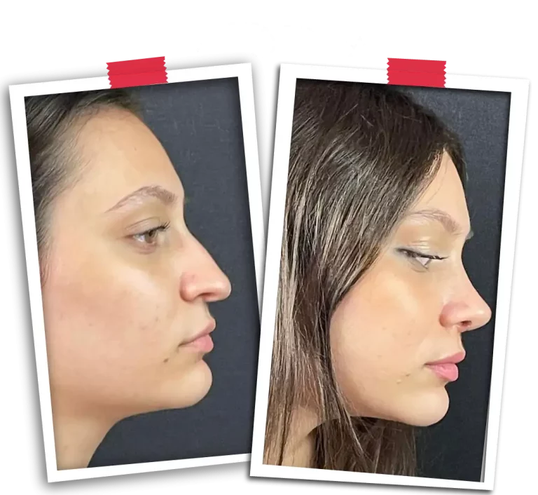 Rinoplasti Before After VP-03
