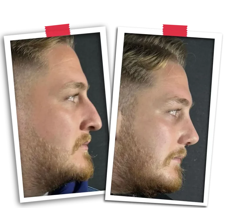 Rinoplasti Before After VP-04