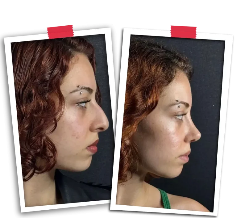 Rinoplasti Before After VP-05