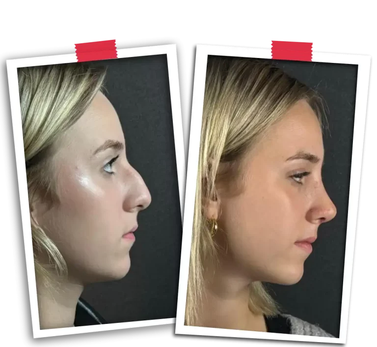 Rinoplasti Before After VP-06