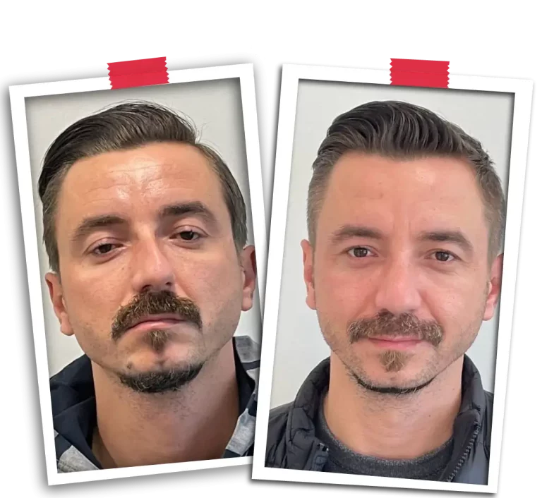 Rinoplasti Before After VP-09