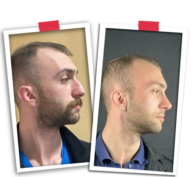 Rinoplasti Before After VP-10