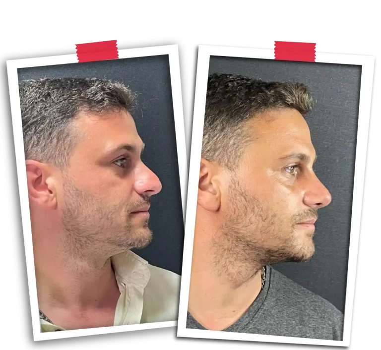 Rinoplasti Before After VP-11