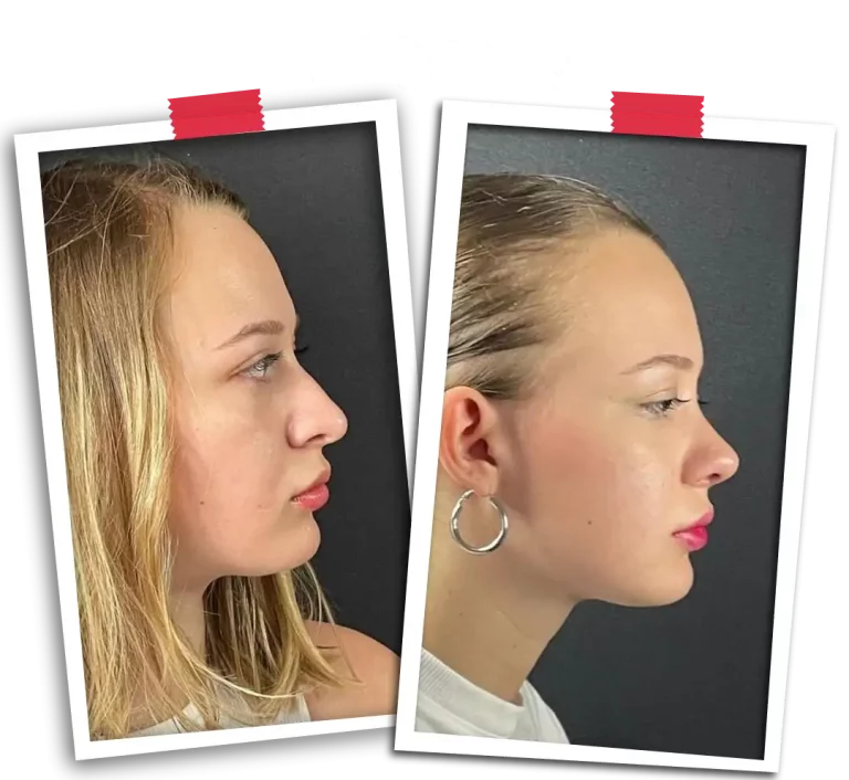 Rinoplasti Before After VP-12