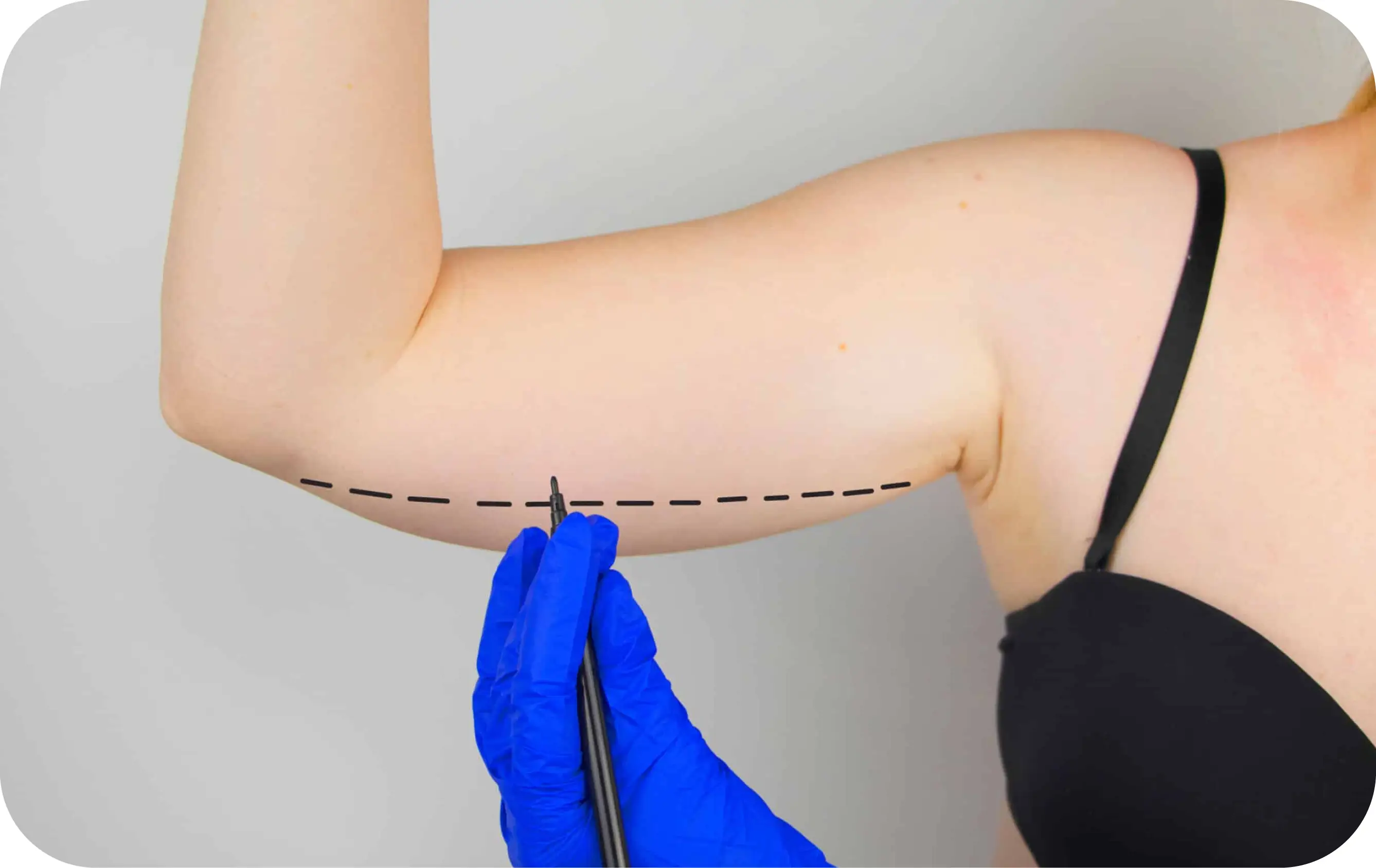 Arm Lift
