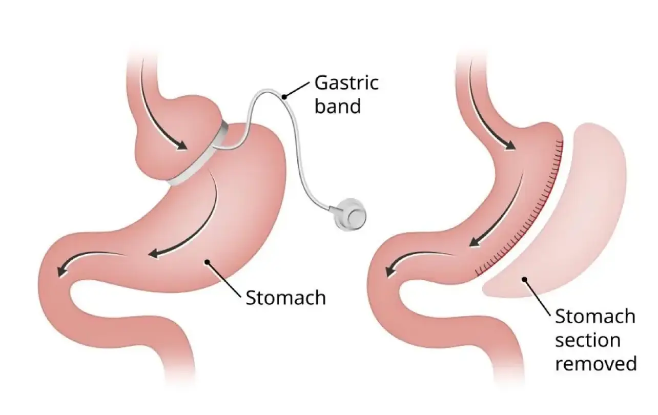 Revisional Bariatric Surgery