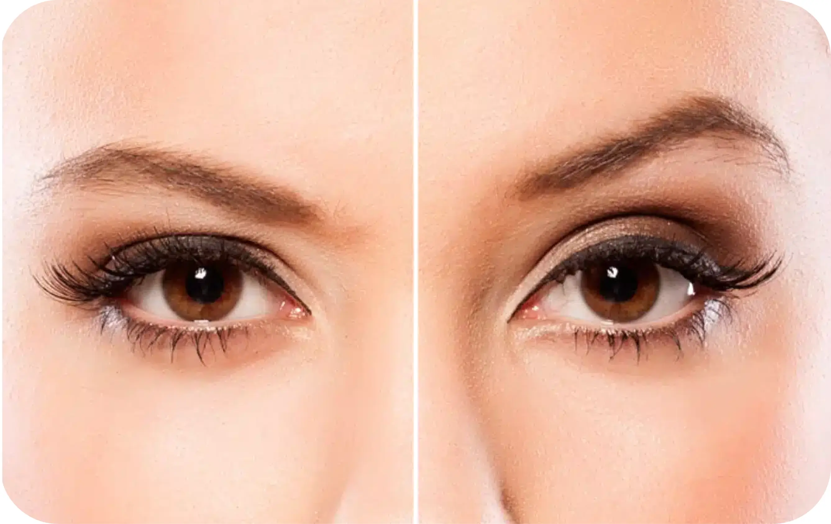Eyebrow Lift