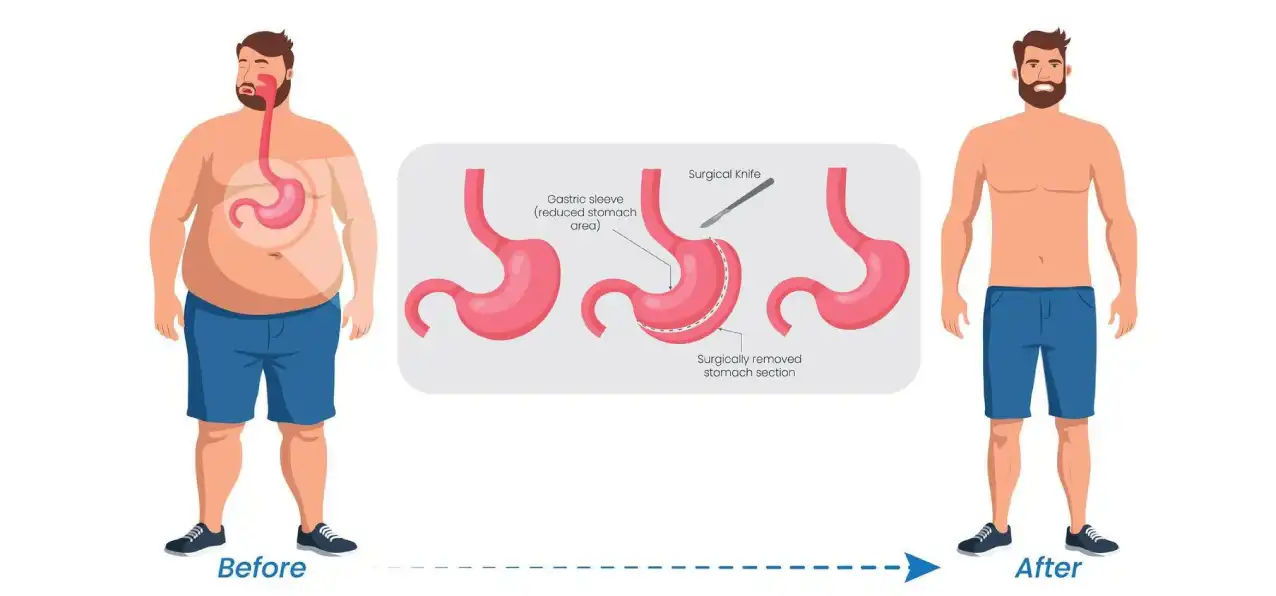 Gastric Sleeve Before and After: How Much Weight Can You Really Expect to Lose?