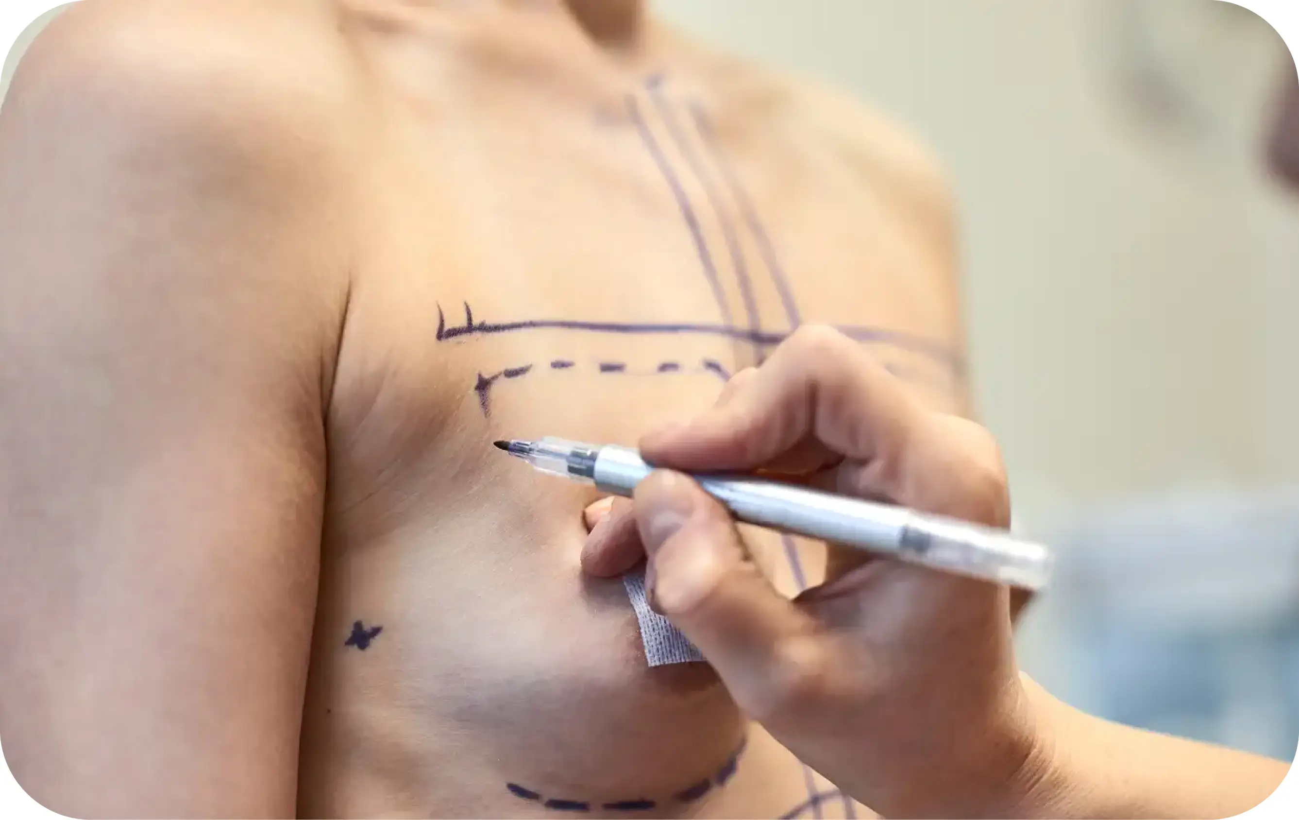 Gynecomastia