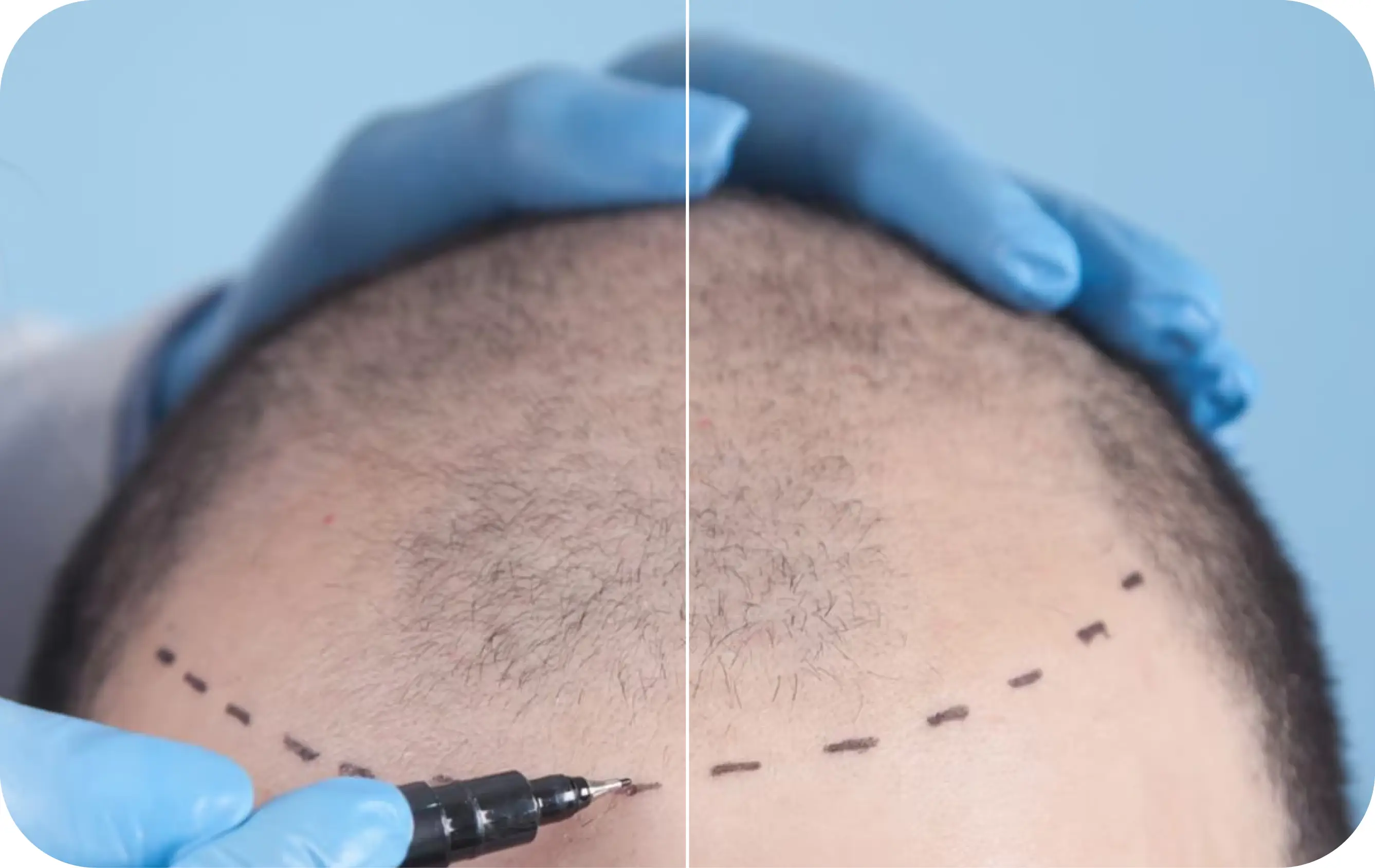 Hair Transplant
