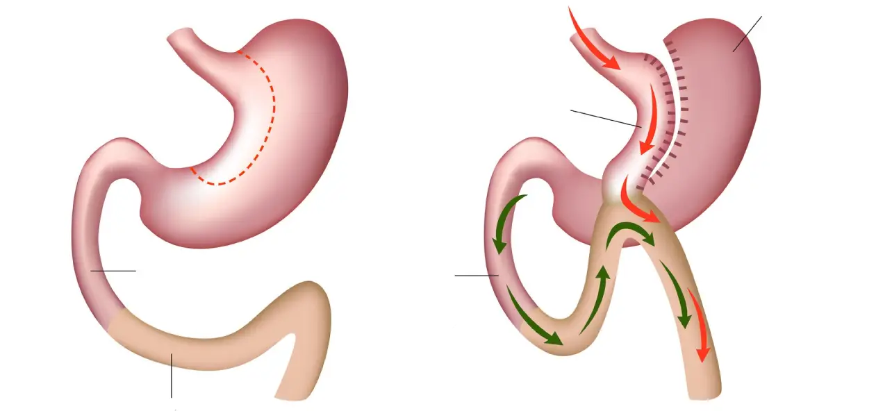 Mini Gastric Bypass