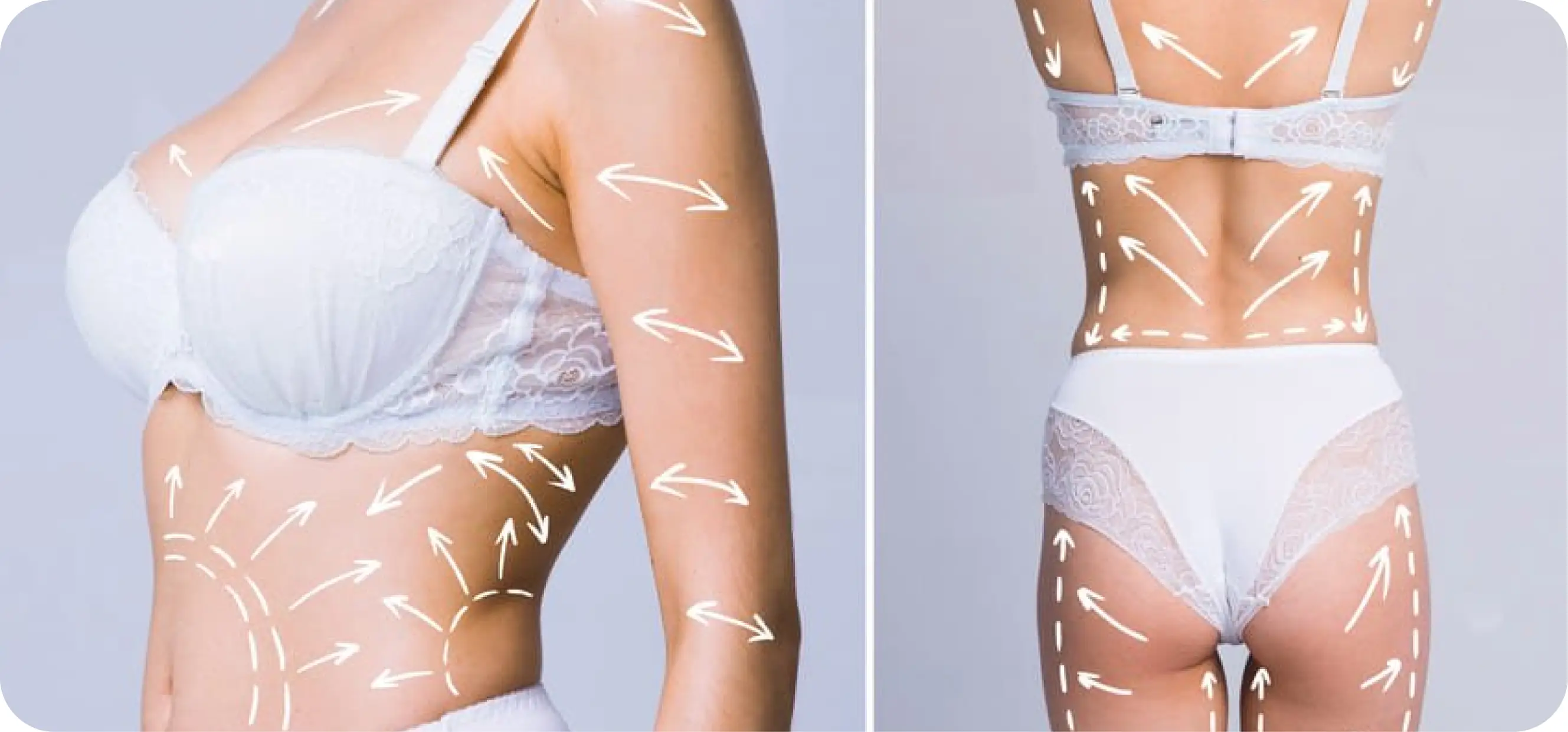Liposuction