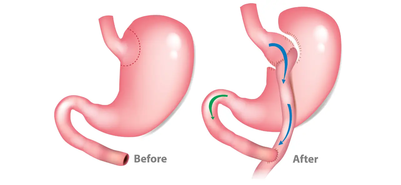 Gastric Bypass