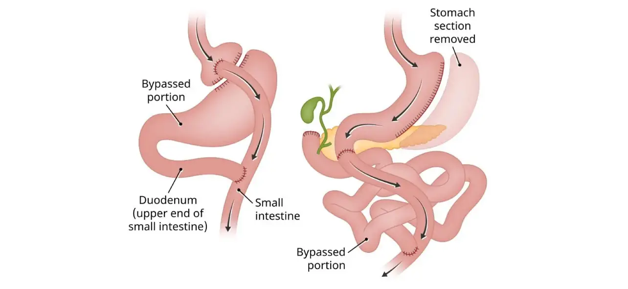 Revisional Bariatric Surgery