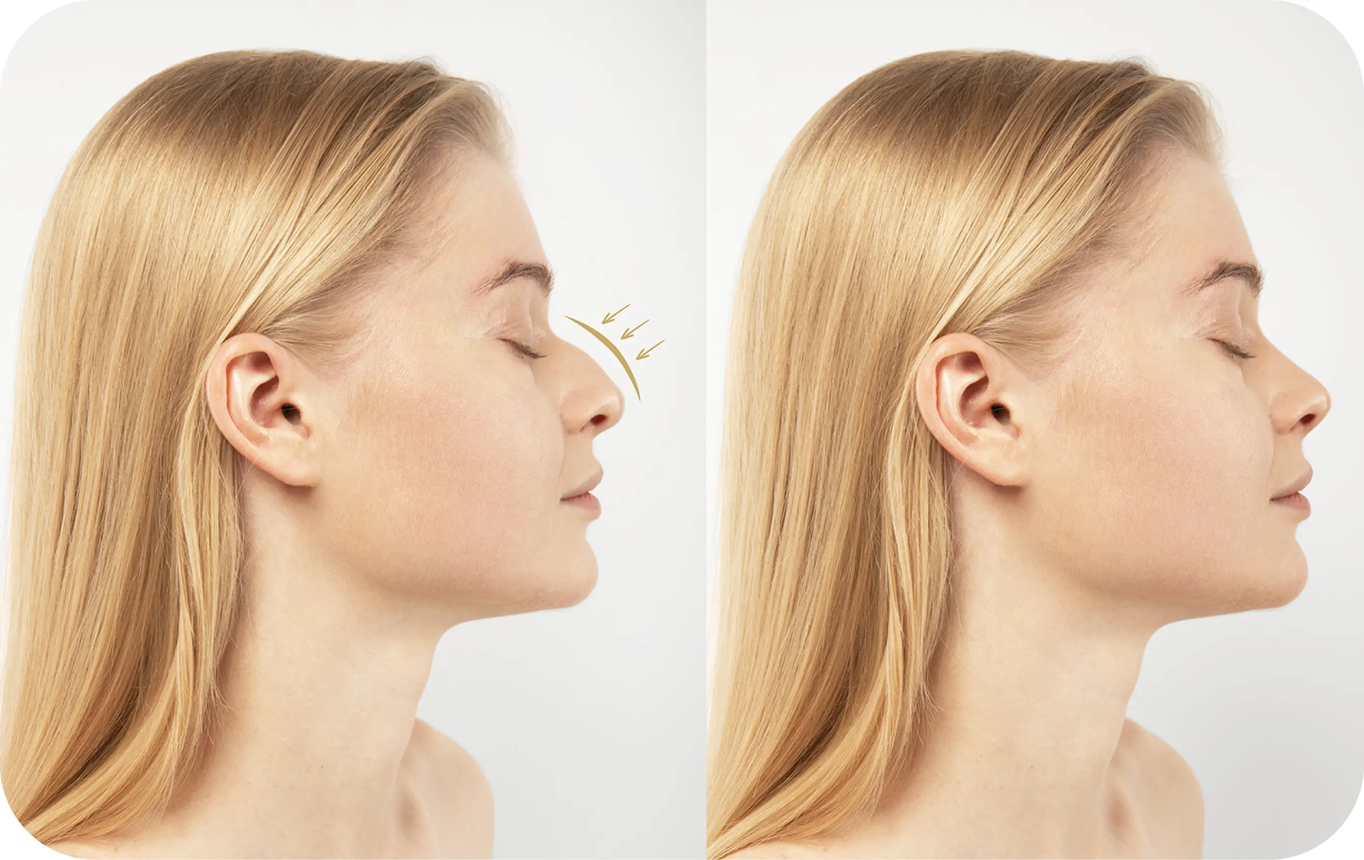 Rhinoplasty