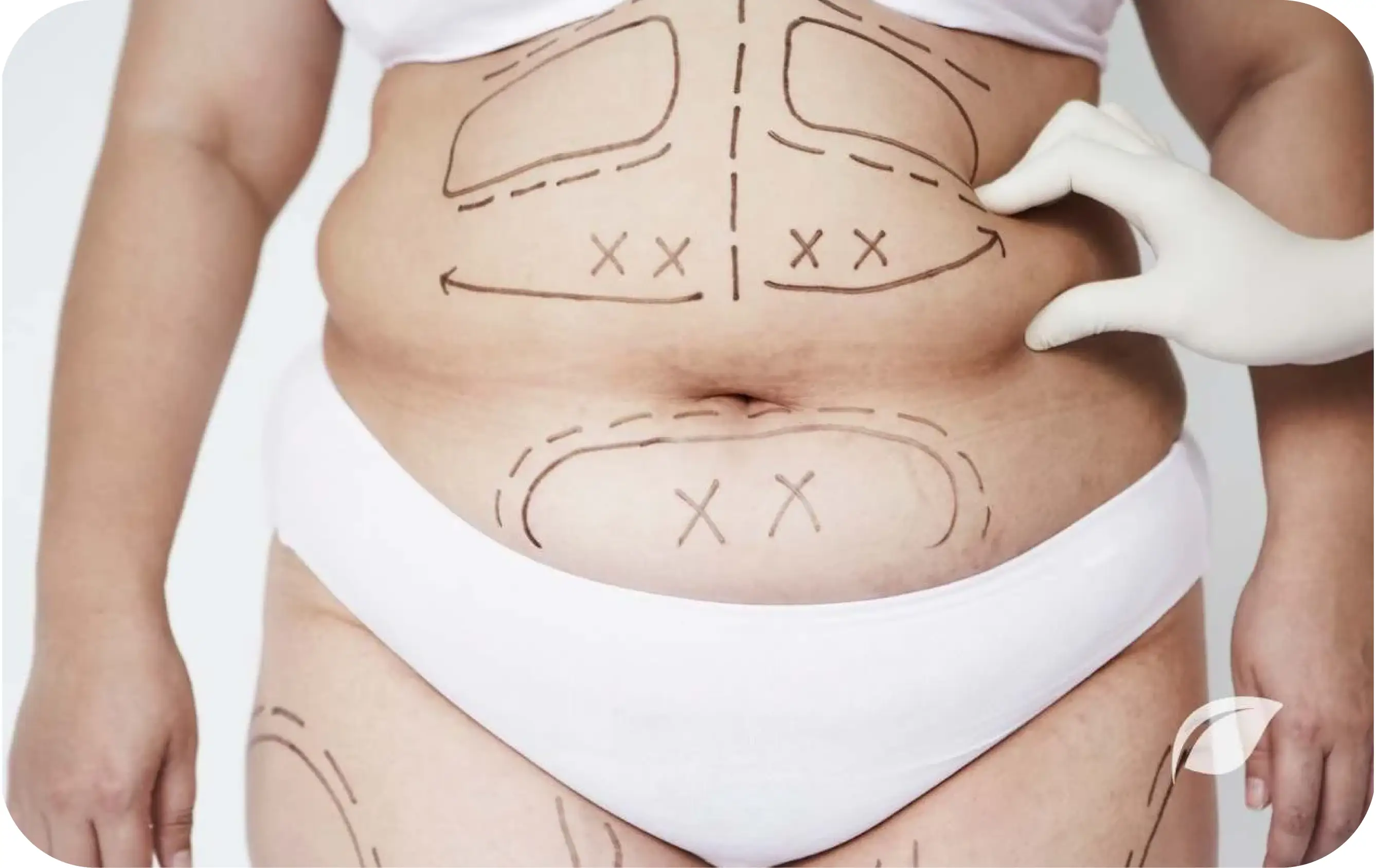 Traditional Liposuction