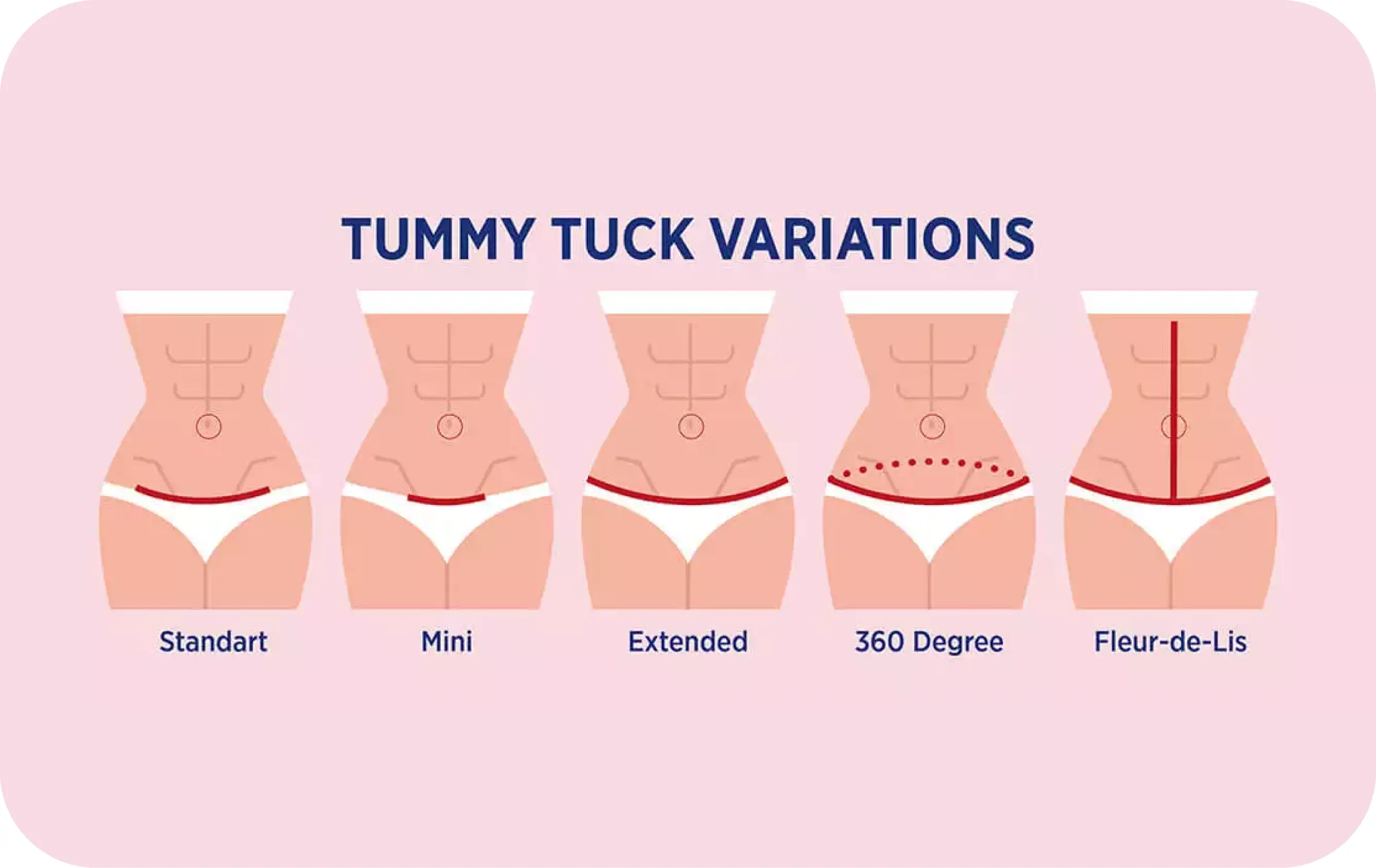 Tummy Tuck Variations