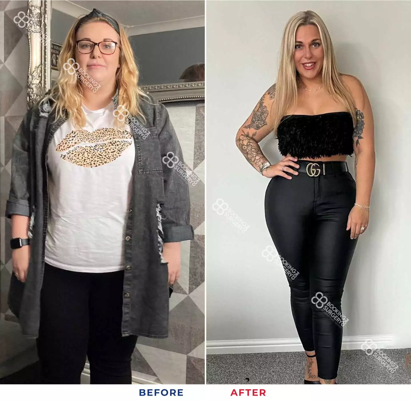 Bariatric Gastric Sleeve Surgery Results - 6 Months Post-Op - Feels Like  Home™