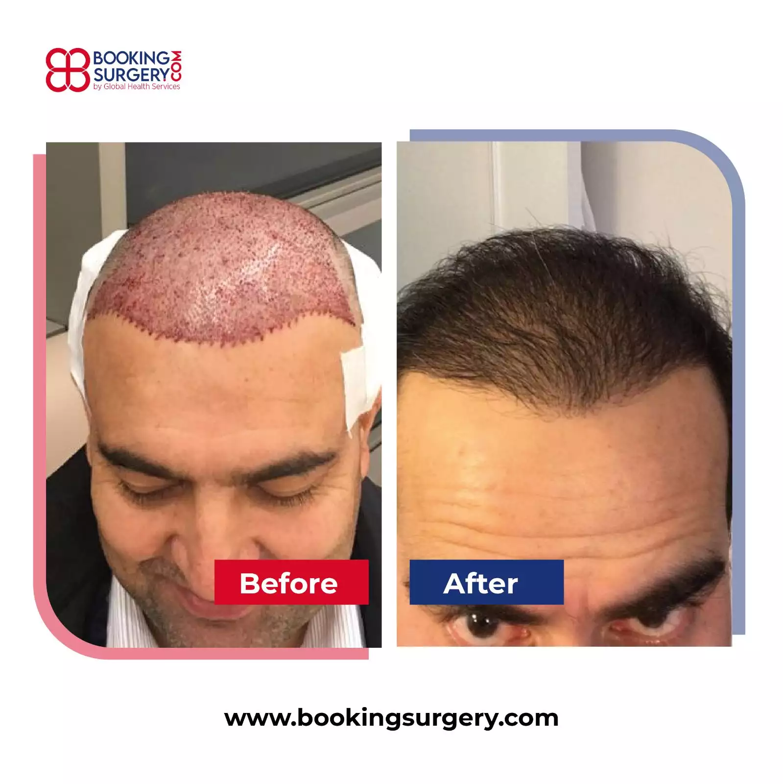 Hair Transplant Cost in Pune | Best Hair Transplant Clinic in Pune