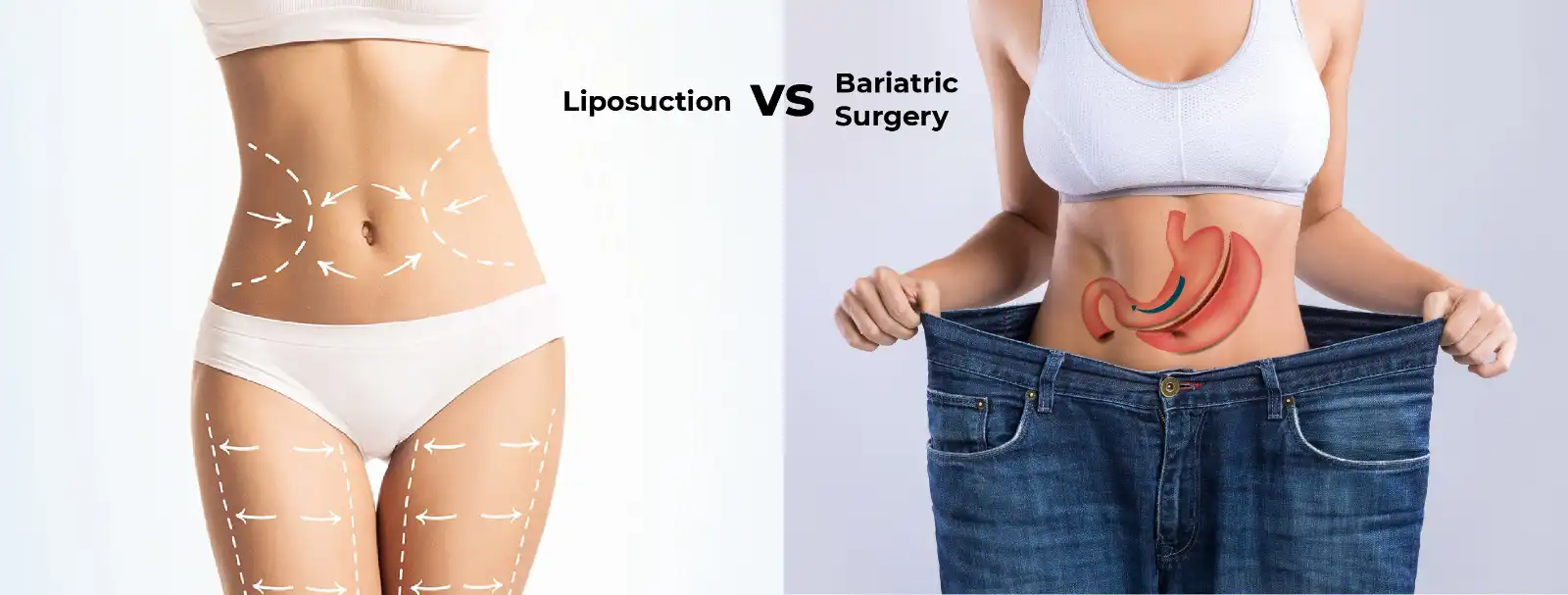Liposuction vs Tummy Tuck: Differences and Procedures