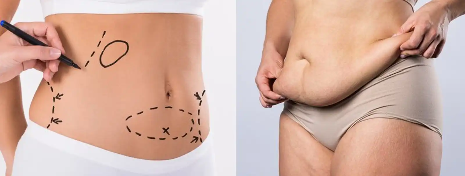 Liposuction vs Tummy Tuck