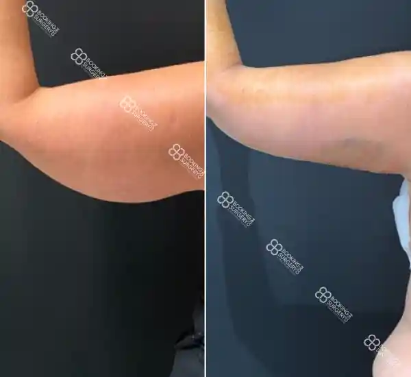 Arm Lift Before and After Photos - Dr Ali