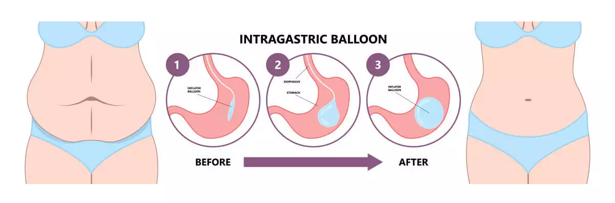 Gastric Balloon, Weight Loss Surgery