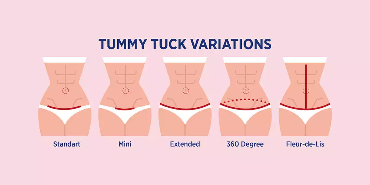 Lower Body Lift vs Tummy Tuck